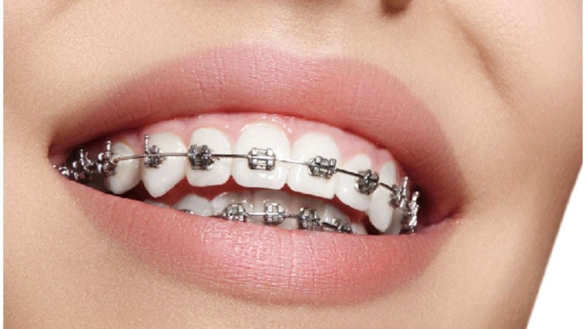 niềng răng mắc cài kim loại