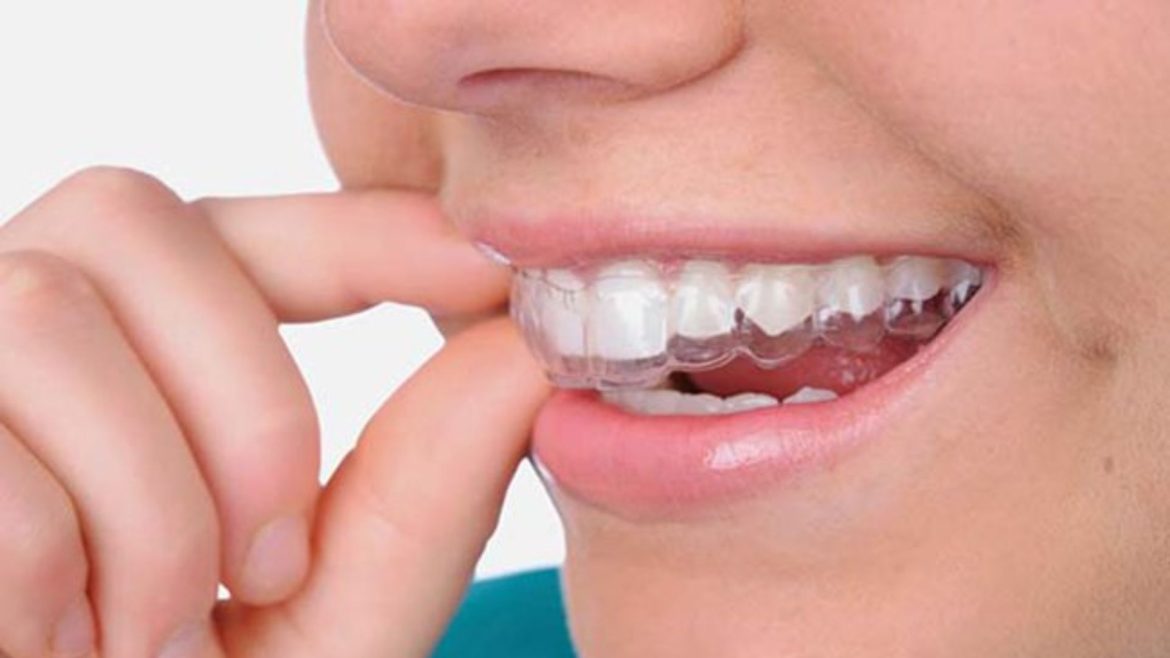 30 tuổi niềng răng được không?