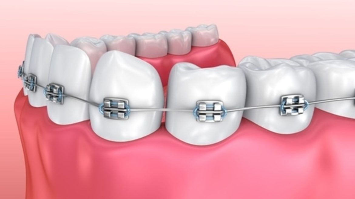 35 tuổi niềng răng được không?