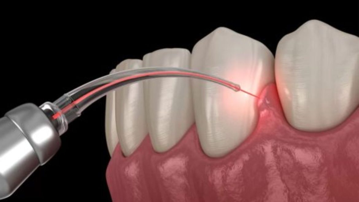 Cắt lợi bao lâu thì lành