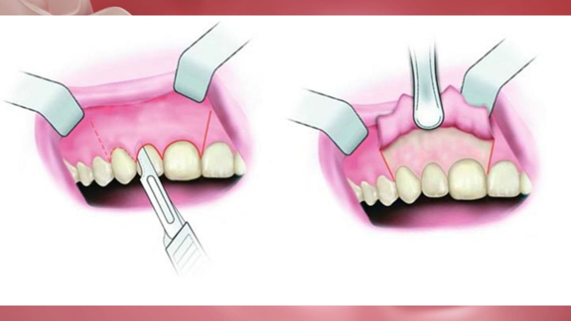 Cắt lợi mài xương ổ răng