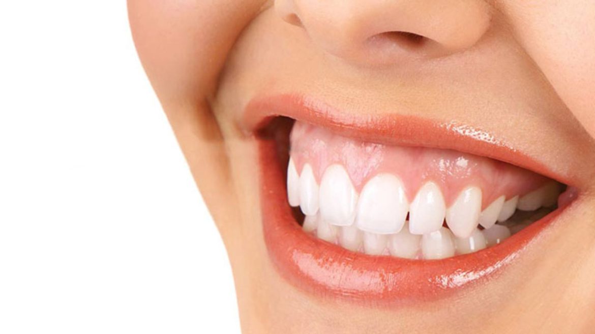 Cắt nướu răng bao nhiêu tiền