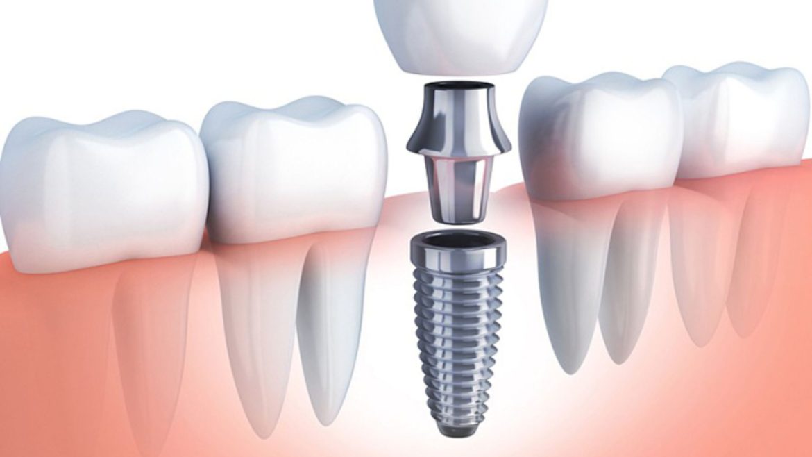 Cấy ghép răng implant ở đâu tốt