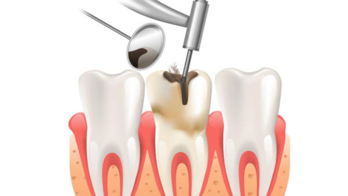 Chữa tủy răng giá bao nhiêu tại nha khoa Big Dental