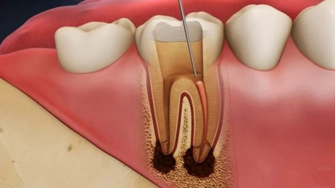 Điều trị tủy răng Quận 1