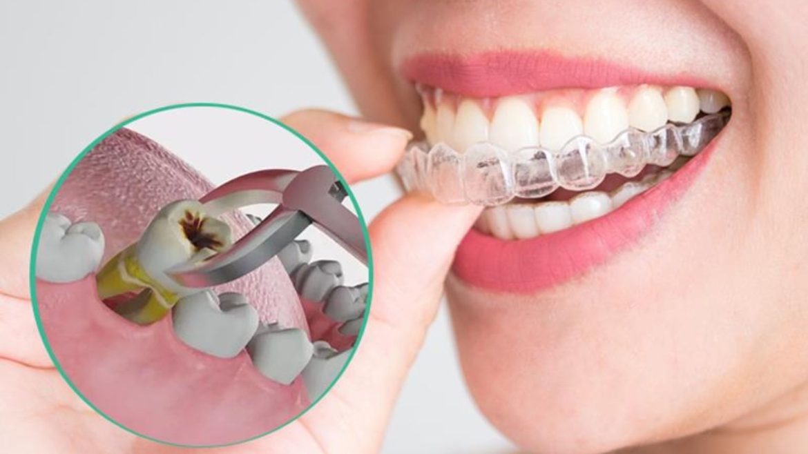 Niềng răng có phải nhổ răng không