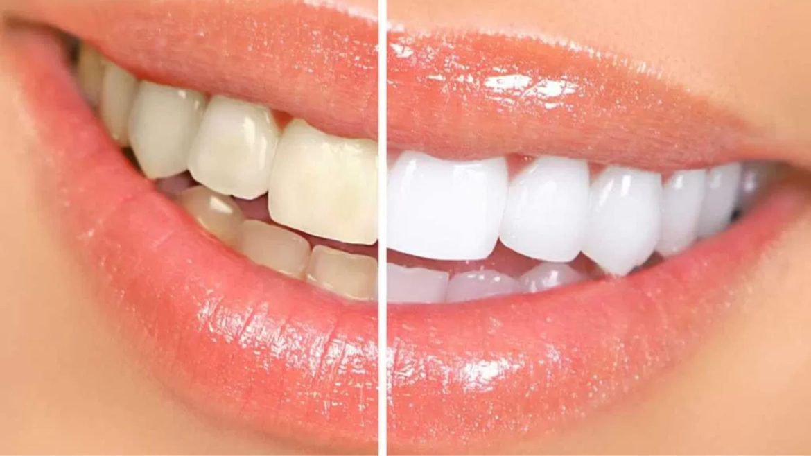 Tẩy trắng răng ở Pleiku