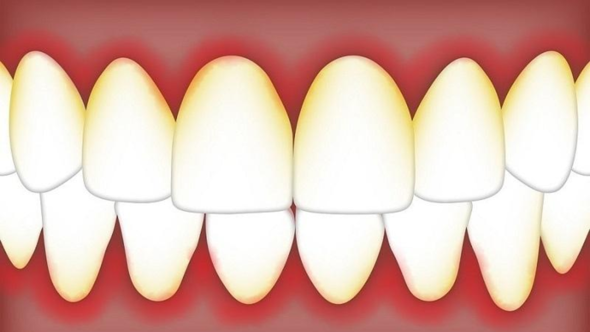 Top 5 loại thuốc trị viêm nha chu hiệu quả