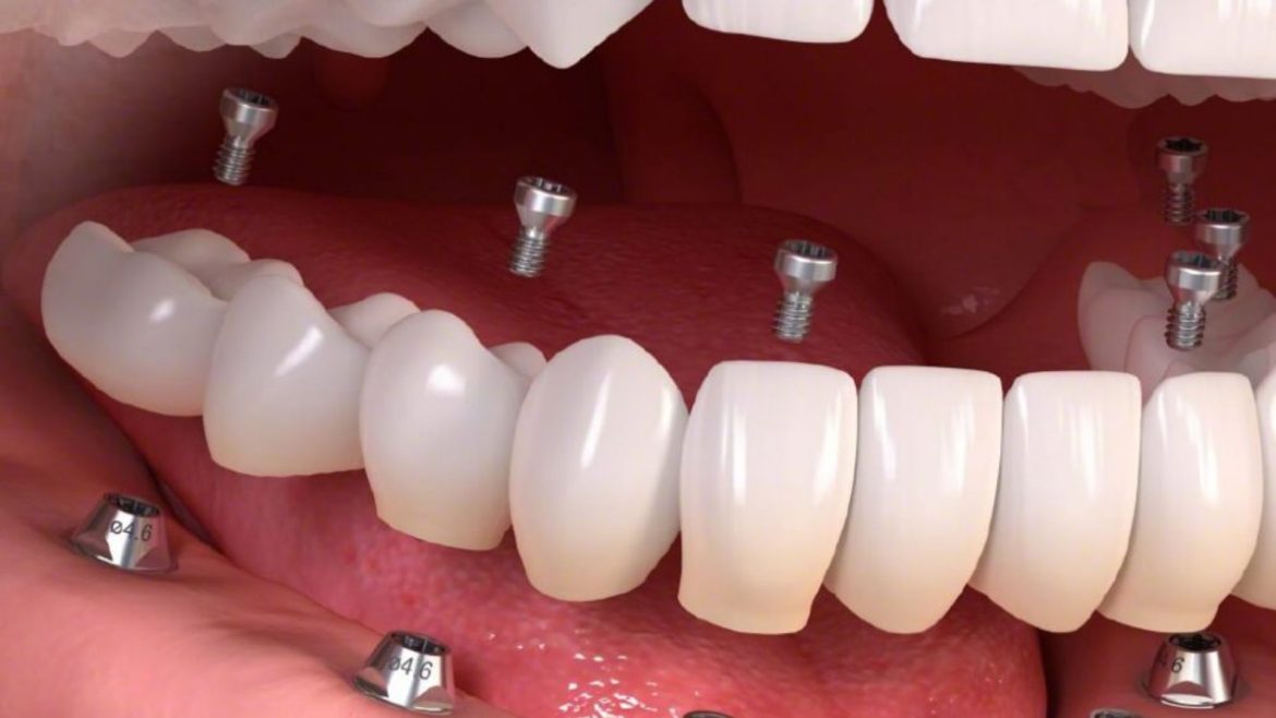 Trồng răng Implant Quận 1