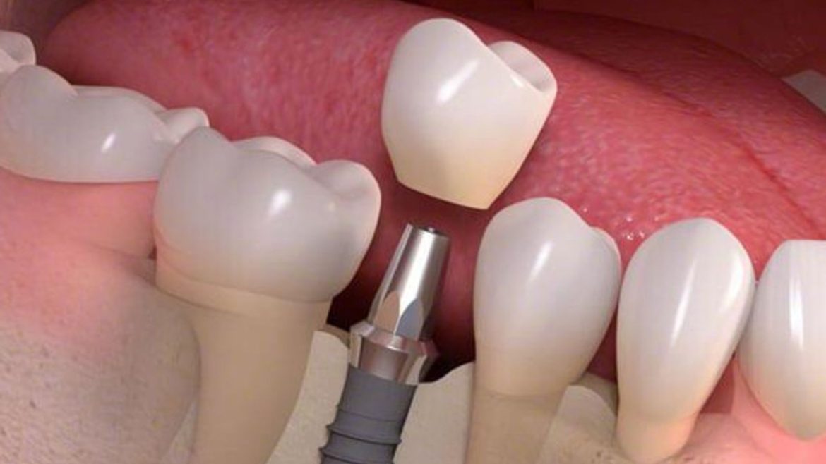 Trồng răng Implant mất bao lâu