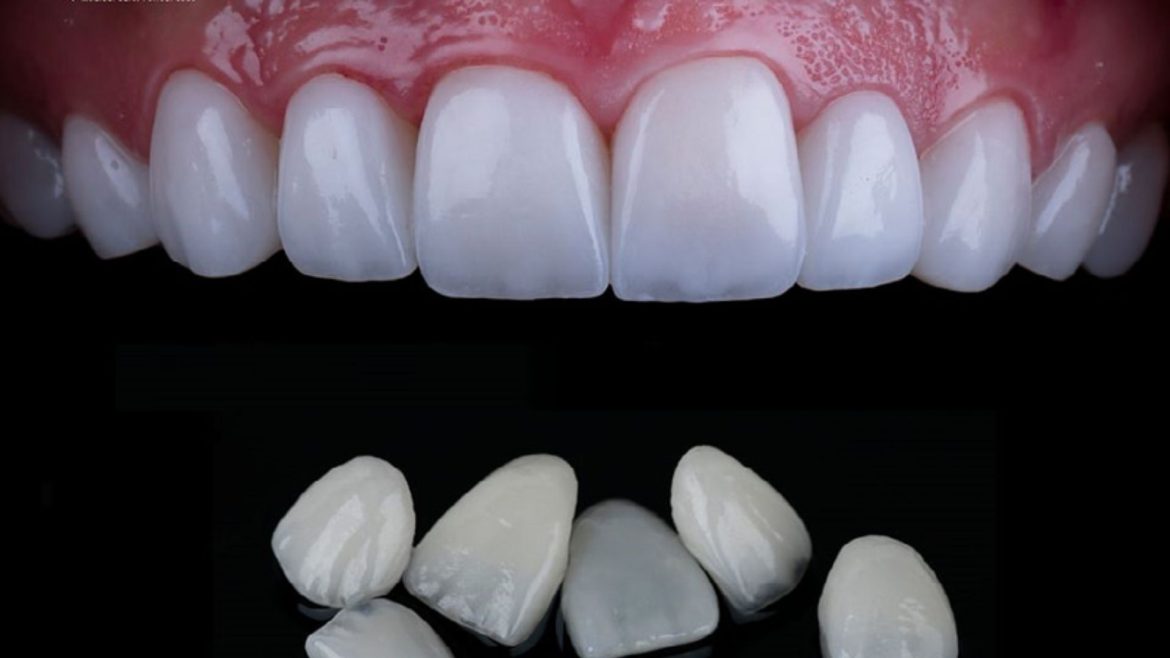 Dán sứ Veneer giá bao nhiêu 1 răng -1