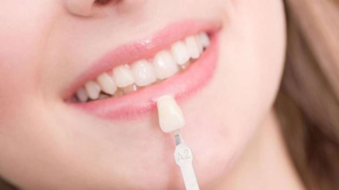 dán sứ veneer pleiku