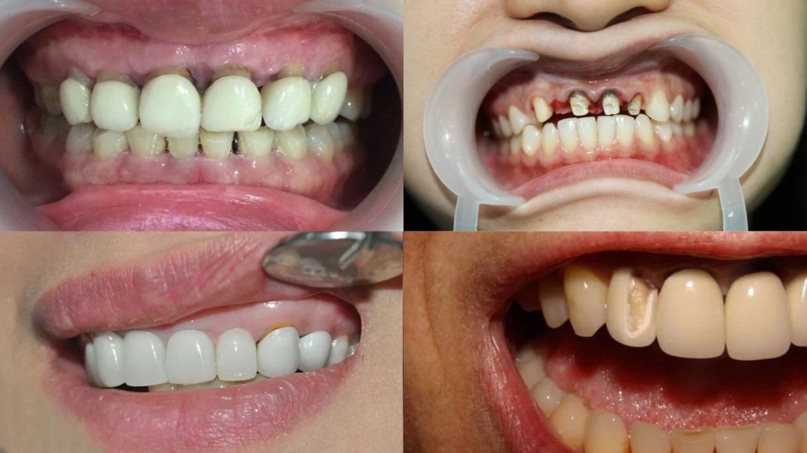 Hậu quả bọc răng sứ -1