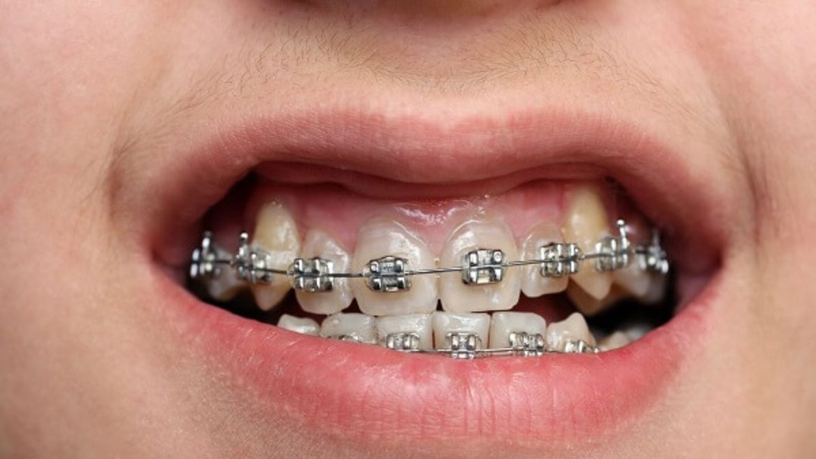 niềng răng bao nhiêu tiền