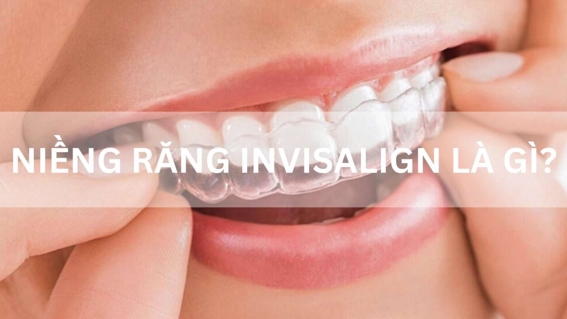 niềng răng invisalign là gì
