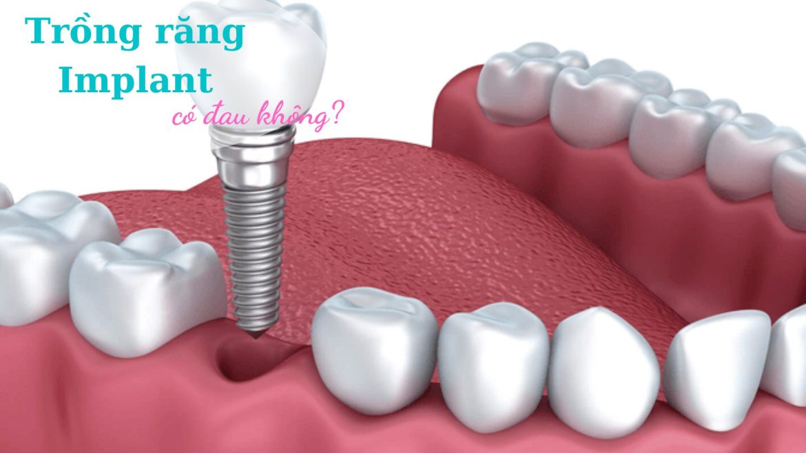 Trồng răng Implant có đau không