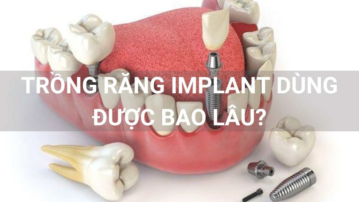 trồng răng implant dùng được bao lâu