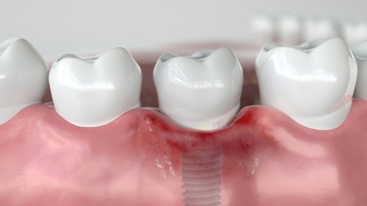 Trồng răng Implant giá rẻ - 1