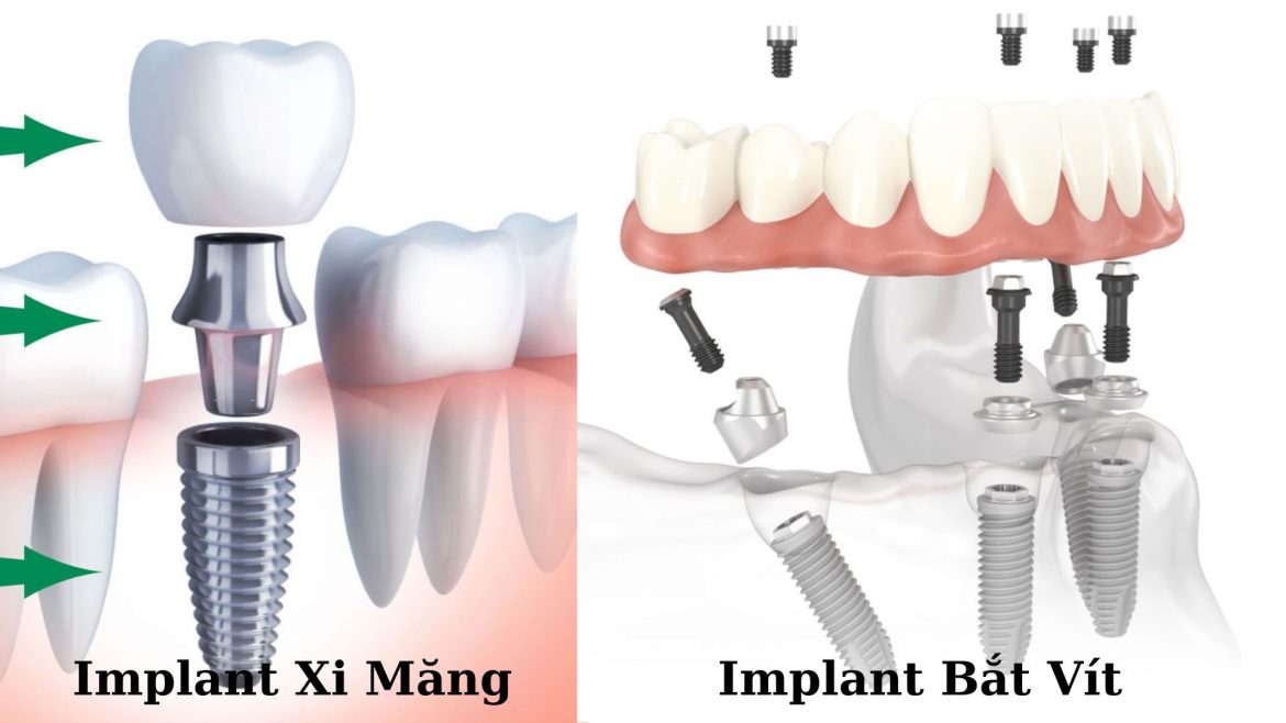Trồng răng Implant xi măng