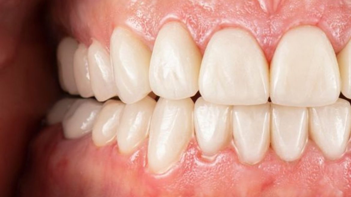 Bọc răng sứ có lấy tủy không - 1