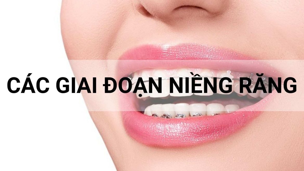 các giai đoạn niềng răng