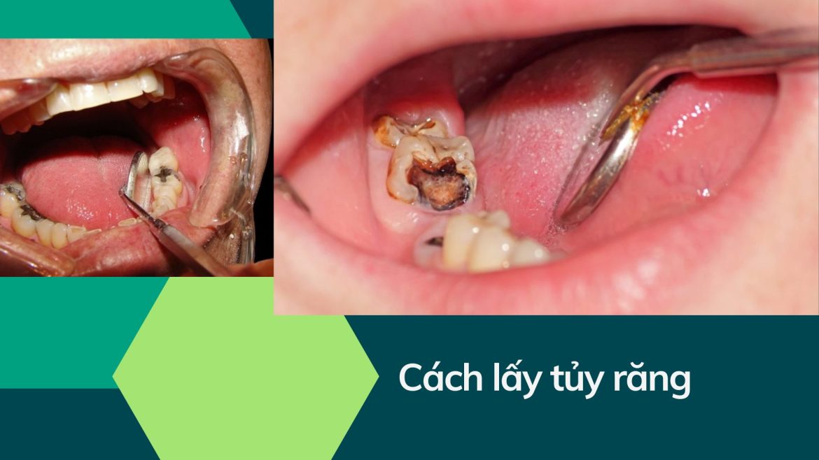 Cách lấy tủy răng-1