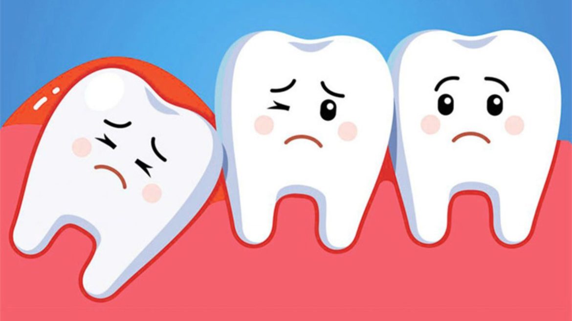 chi phí cắt lợi trùm giá bao nhiêu