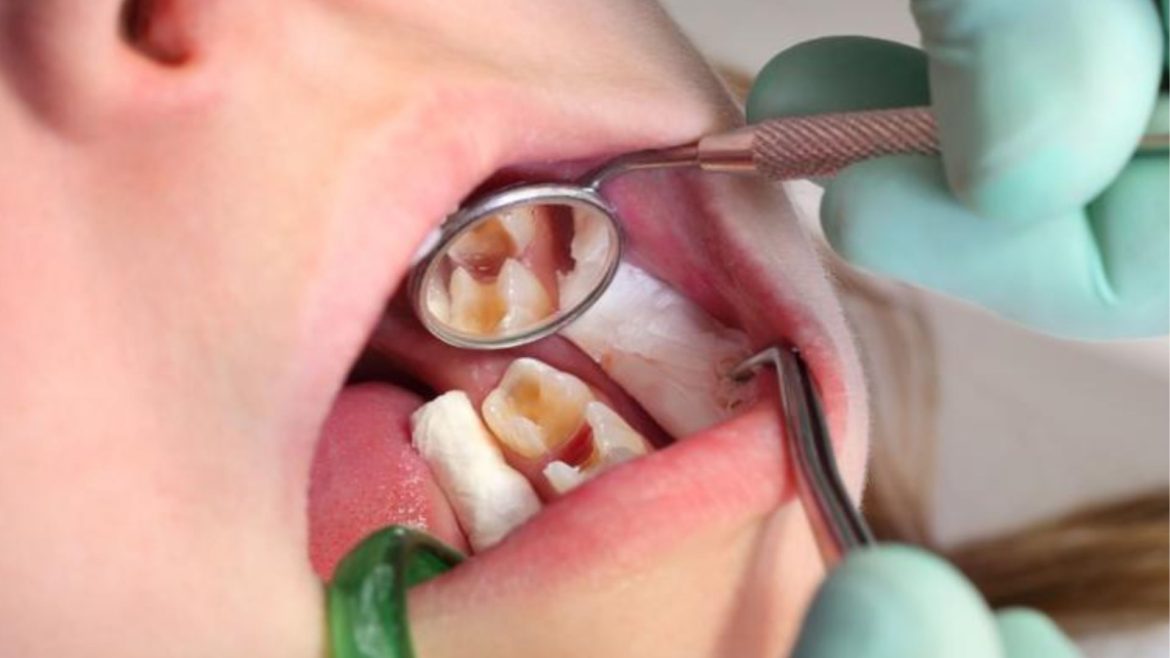 Chữa tủy răng bị đau nguyên nhân và cách khắc phục