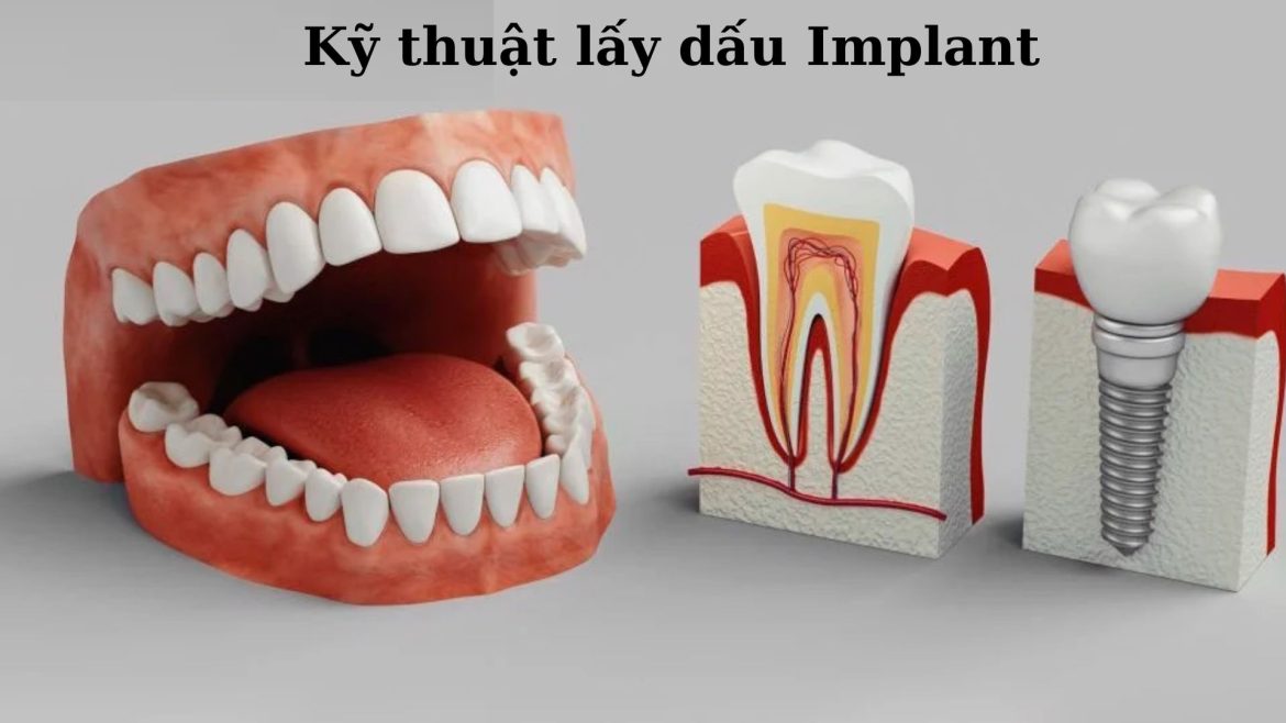 Lấy dấu Implant là gì -1