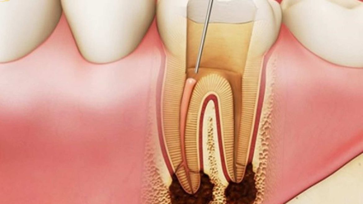 lấy tủy răng có đau không