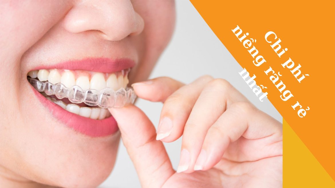 Niềng răng rẻ nhất -1
