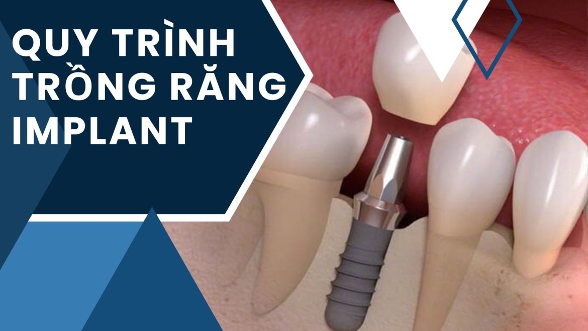 Quy trình trồng răng implant - 1