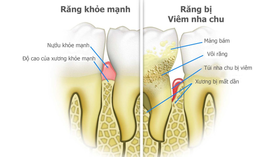 Thuốc bôi chữa viêm nha chu