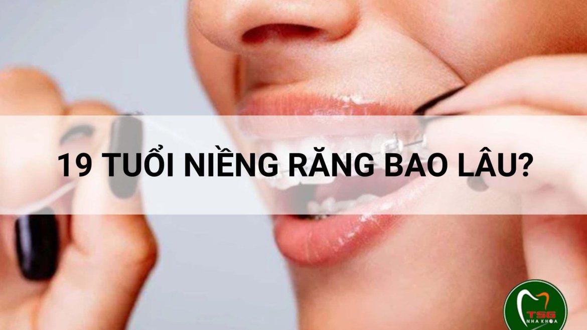 19 tuổi niềng răng bao lâu