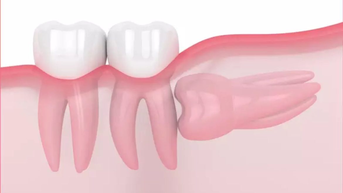 Nhổ răng khôn - 1