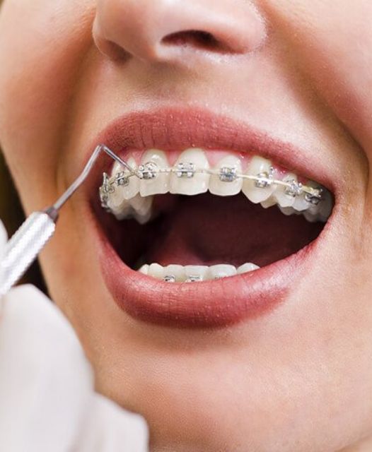 Niềng răng 7 Niềng răng 7
