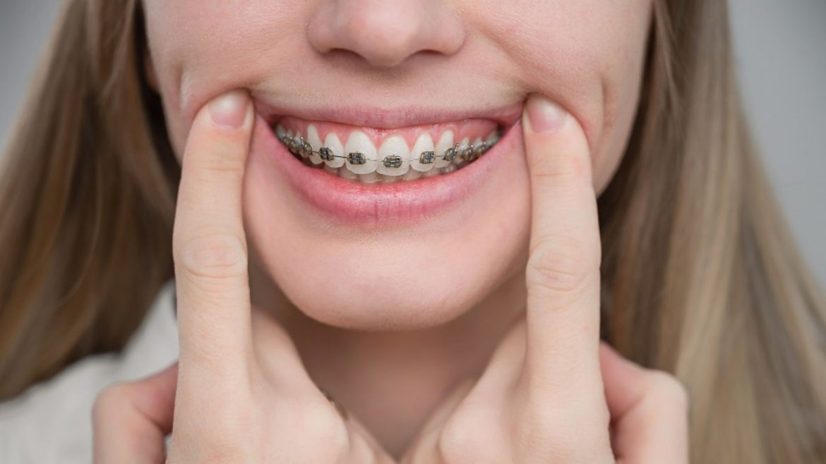 Niềng răng có đau không - 2