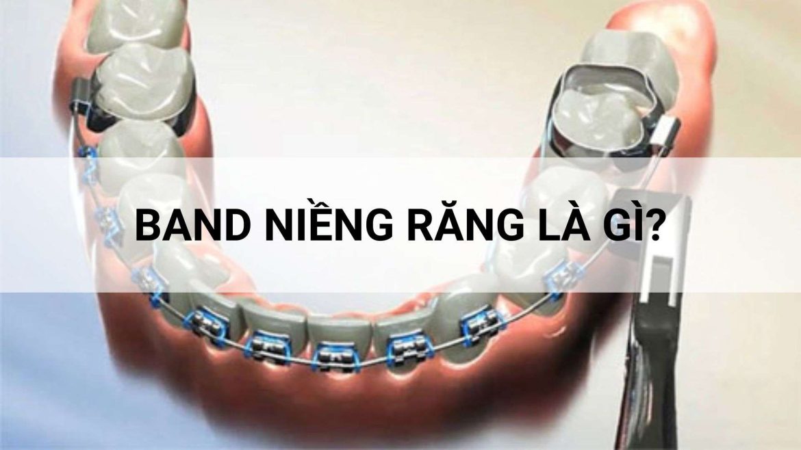band niềng răng