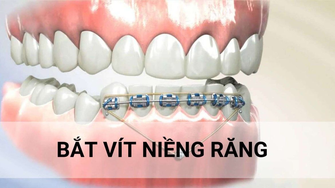 bắt vít niềng răng