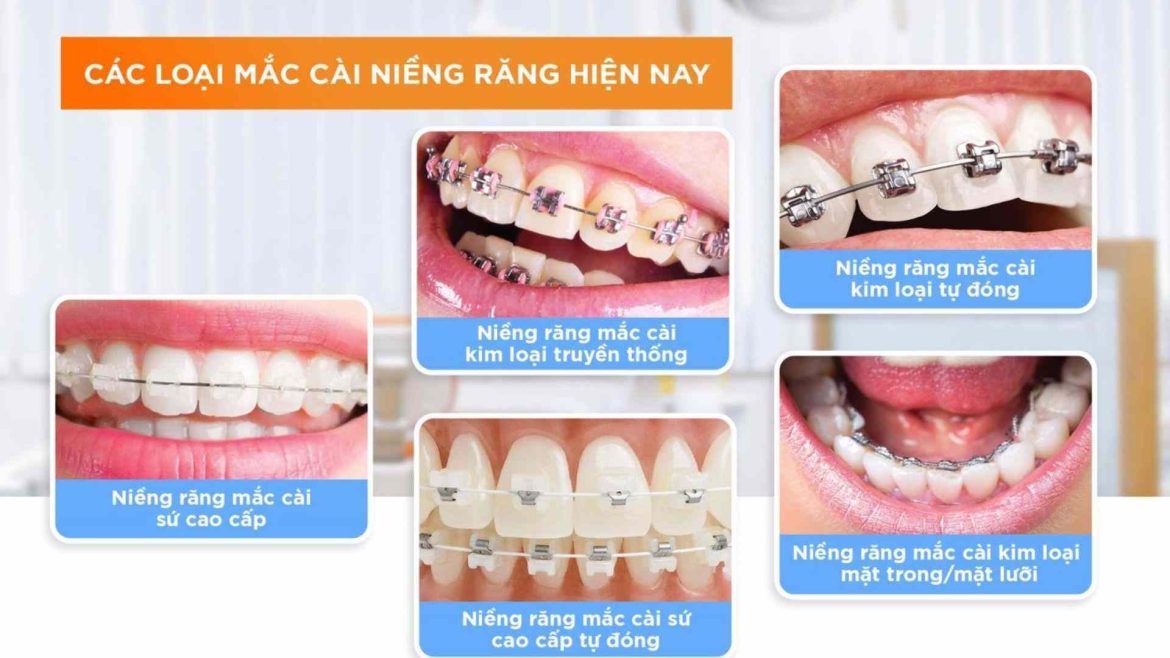 các loại mắc cài niềng răng