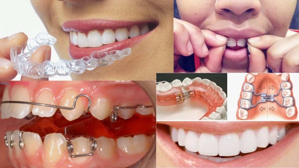 Cách niềng răng tại nhà -1