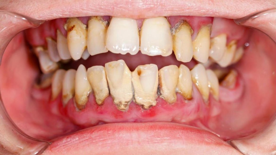 Cao răng là gì -1