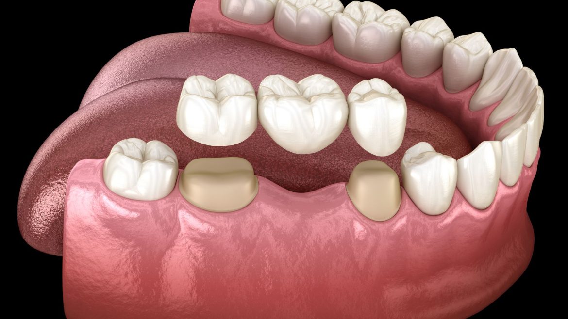 Cầu răng sứ - 1