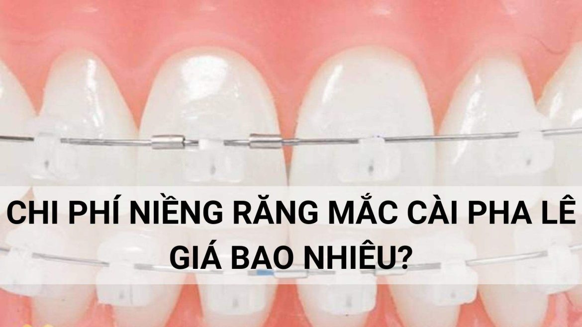 chi phí niềng răng mắc cài pha lê
