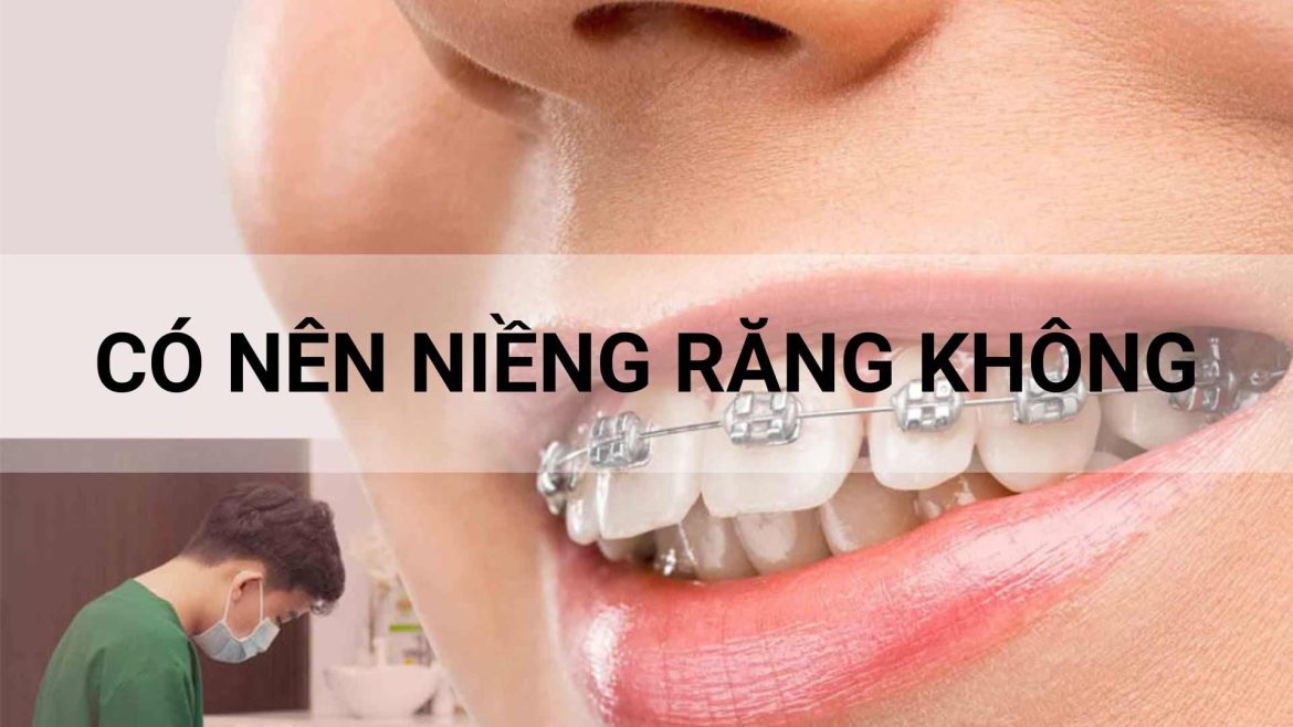 có nên niềng răng không