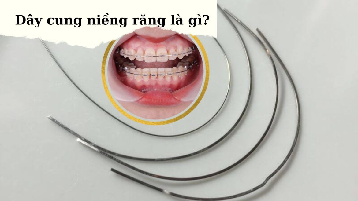 Dây cung niềng răng - 1