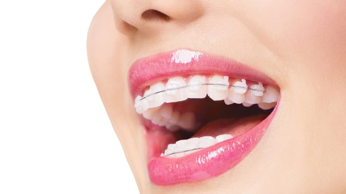 niềng răng có tác dụng gì