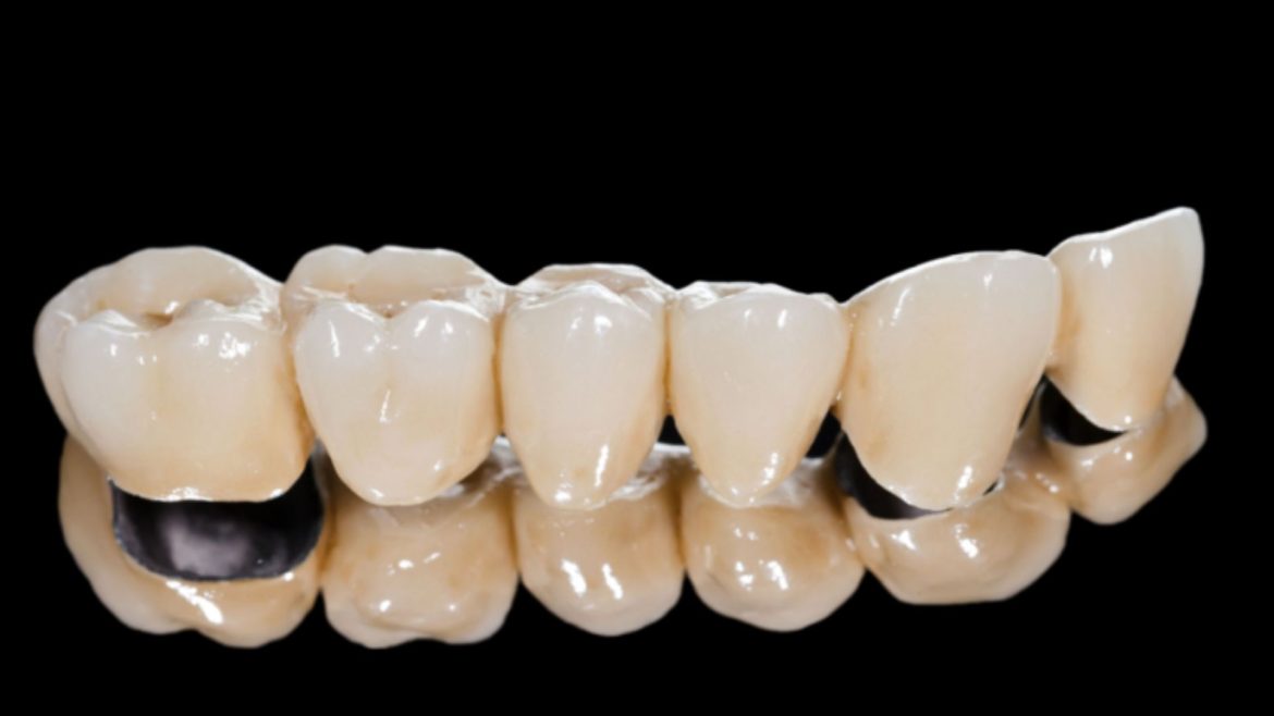 Răng sứ Titan - 1