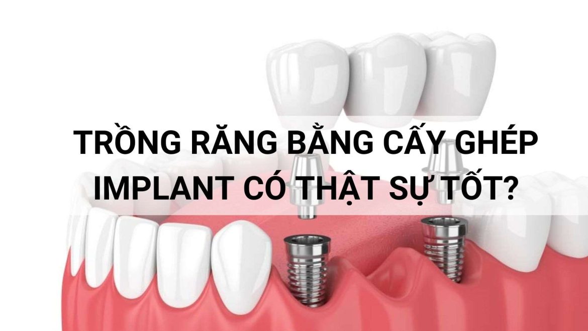 trồng răng bằng cấy ghép Implant có thật sự tốt