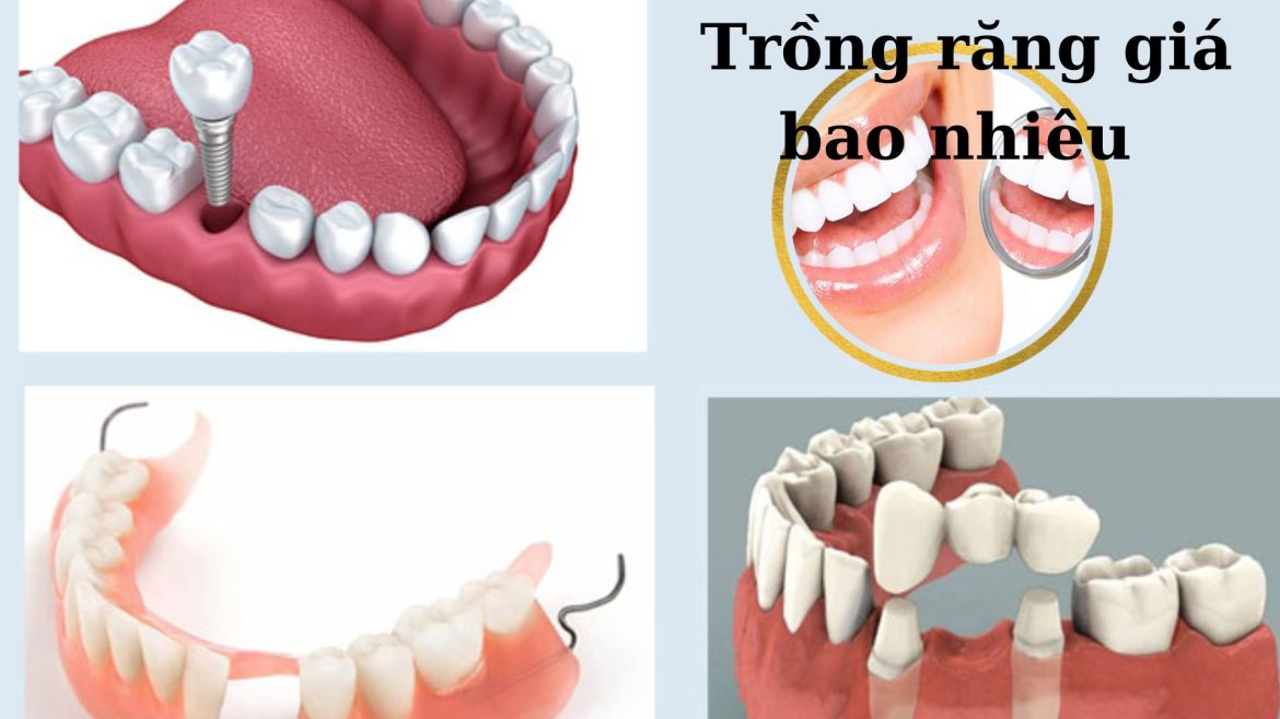 Trồng răng giá bao nhiêu - 1